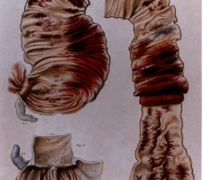 Plaat met door cholera aangetaste darmen uit: "Anatomie pathologique du corps humain, ou Descriptions, avec figures lithographiées et coloriées," par J. Cruveilhier 1829-1842